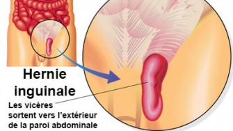 Cure de hernie inguinale : quelle est la meilleure approche ?