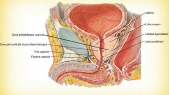 Le cancer de la prostate