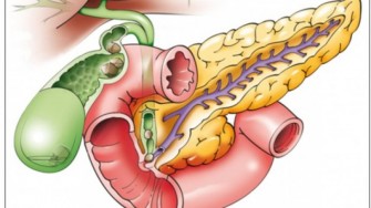 Carcinome des voies biliaires avancés et/ou métastatiques : survie globale améliorée par l’association cisplatine gemcitabine.