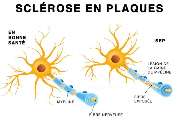 30 Mai : Journée mondiale de la sclérose en plaques