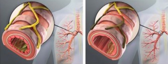 Bronchopneumopathie chronique obstructive (BPCO)