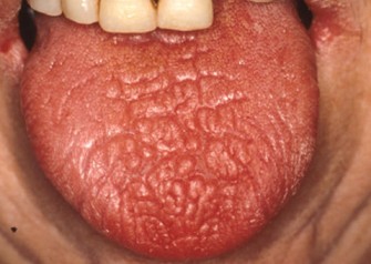 Le syndrome de Gougerot-Sj&ouml;gren