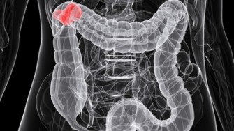 Carcinogenèse colorectale