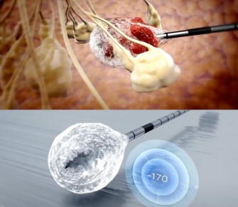 La cryoablation