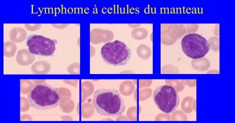 Lymphome du manteau