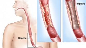 La myotomie de Heller dans le mégaoesophage expose-t-elle au cancer ?