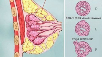 Les carcinomes du sein triple négatif