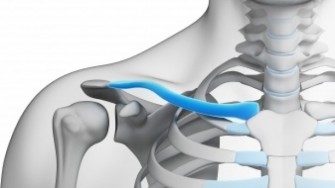 Fracture de clavicule : état de l’art