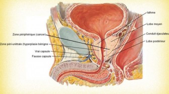 Le cancer de la prostate