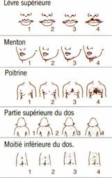  Score de l'hirsutisme (selon Ferriman et Gallwey)