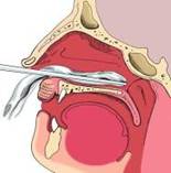 Tamponnement du nez