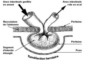 Etranglement herniaire