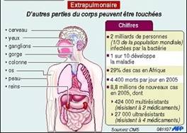 Tuberculose, maladie contagieuse